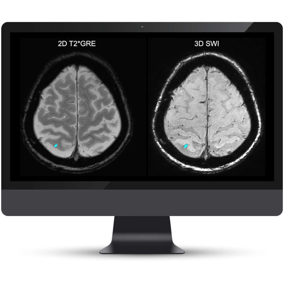 Cortechs.ai|NeuroQuant ARIA