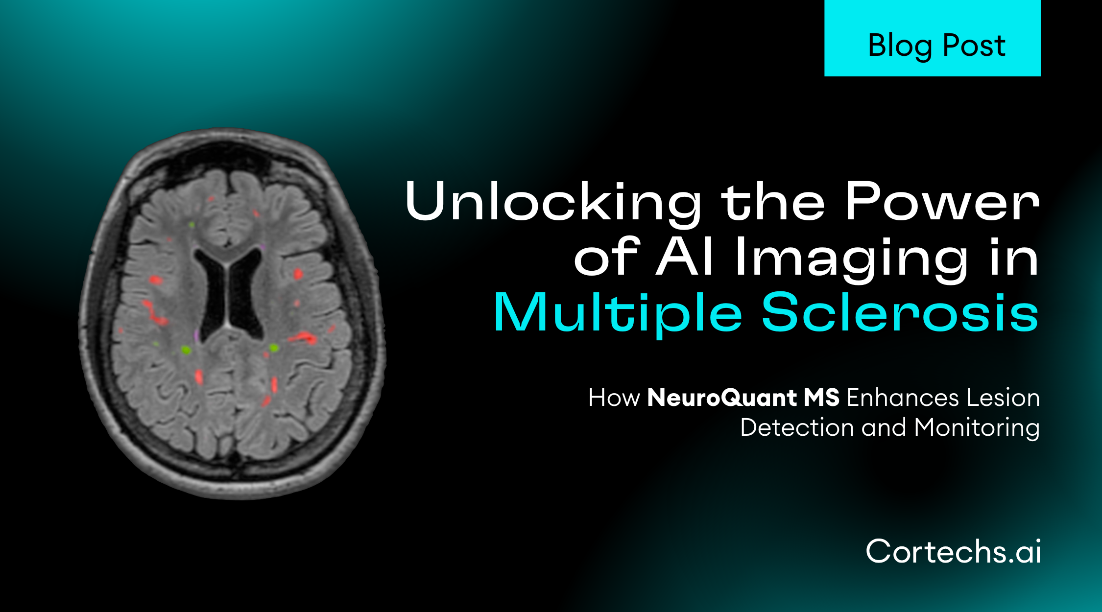 Cortechs.ai|Unlocking the Power of AI Imaging in Multiple Sclerosis: How NeuroQuant® MS Enhances Lesion Detection and Monitoring