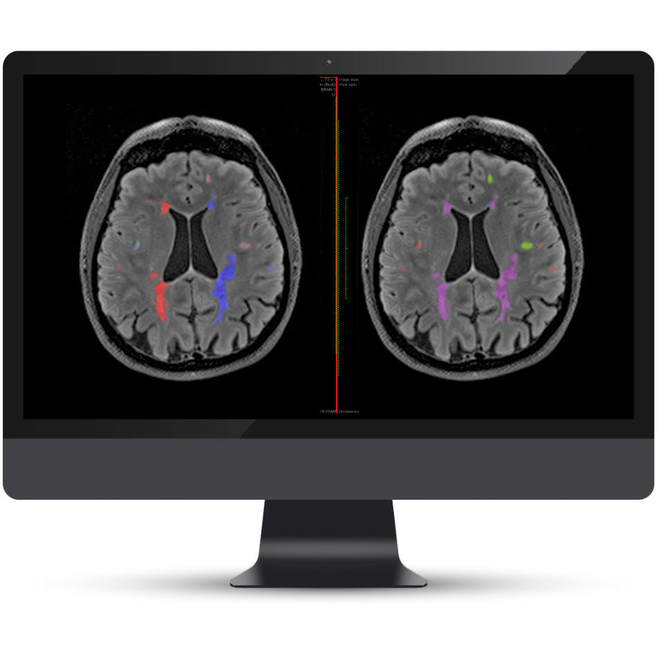 Cortechs.ai|NeuroQuant MS