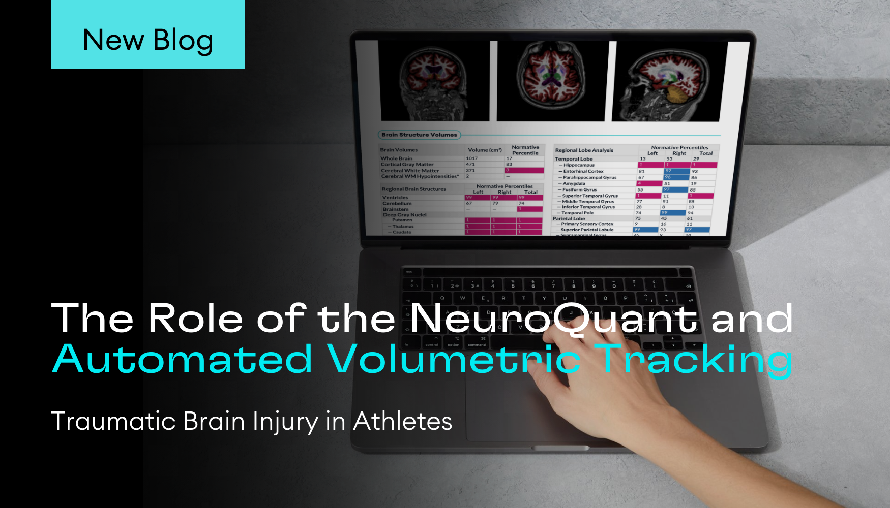 Cortechs.ai | Traumatic Brain Injury in Athletes: The Role of the NeuroQuant and Automated Volumetric Tracking